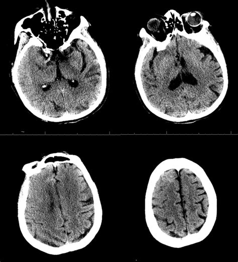 pontine infarction icd 10|icd 10 pontine hemorrhage.